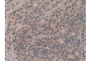 IHC-P analysis of Human Prostate Gland Cancer Tissue, with DAB staining. (MTOR 抗体  (AA 2226-2488))