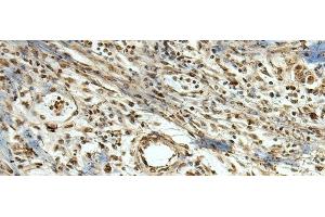 Immunohistochemistry of paraffin-embedded Human breast cancer tissue using MLF1 Polyclonal Antibody at dilution of 1:105(x200) (MLF1 抗体)