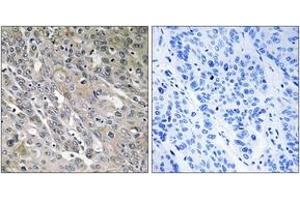 Immunohistochemistry analysis of paraffin-embedded human lung carcinoma tissue, using ARHGEF9 Antibody. (Arhgef9 抗体  (AA 399-448))