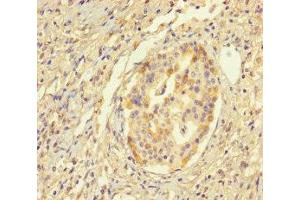 Immunohistochemistry of paraffin-embedded human pancreatic cancer using ABIN7155943 at dilution of 1:100 (Chromosome X Open Reading Frame 27 (CXORF27) (AA 1-117) 抗体)