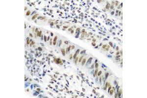 Immunohistochemistry of paraffin-embedded human colon carcinoma using CASP9 antibody (ABIN4903132) at dilution of 1:100 (40x lens). (Caspase 9 抗体)