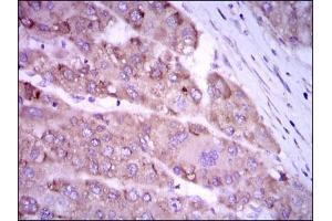 Immunohistochemical analysis of paraffin-embedded liver cancer tissues using NOS2 mouse mAb with DAB staining. (NOS2 抗体)