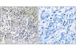 Immunohistochemistry analysis of paraffin-embedded human breast carcinoma tissue, using SESN1 Antibody. (SESN1 抗体  (AA 271-320))
