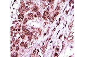 IHC analysis of FFPE human hepatocarcinoma tissue stained with the GSK3B antibody (GSK3 beta 抗体  (AA 4-34))