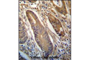 NETO2 Antibody (N-term ) (ABIN657245 and ABIN2846343) immunohistochemistry analysis in formalin fixed and paraffin embedded human colon carcinoma followed by peroxidase conjugation of the secondary antibody and DAB staining. (NETO2 抗体  (N-Term))