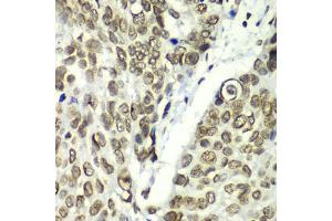 Immunohistochemistry of paraffin-embedded human esophageal cancer using TEAD1 antibody (ABIN6291475) at dilution of 1:100 (40x lens). (TEAD1 抗体)