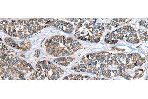 Immunohistochemistry of paraffin-embedded Human esophagus cancer tissue using CADM2 Polyclonal Antibody at dilution of 1:40(x200) (CADM2 抗体)