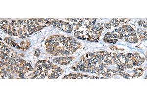 Immunohistochemistry of paraffin-embedded Human esophagus cancer tissue using CADM2 Polyclonal Antibody at dilution of 1:40(x200) (CADM2 抗体)