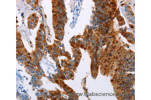 Immunohistochemistry of Human colon cancer using TFF3 Polyclonal Antibody at dilution of 1:50 (TFF3 抗体)