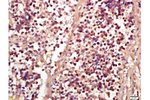 Formalin-fixed and paraffin embedded human lung carcinoma labeled with Anti-Phospho-RSK2 (Ser227) Polyclonal Antibody, Unconjugated (ABIN745268) at 1:200 followed by conjugation to the secondary antibody and DAB staining (RPS6KA3 抗体  (pSer227))