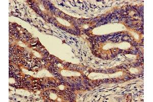 Immunohistochemistry of paraffin-embedded human colon cancer using ABIN7146807 at dilution of 1:100 (CEACAM7 抗体  (AA 36-242))