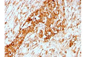 Formalin-fixed, paraffin-embedded human Breast stained with Alpha-1-Antitrypsin Recombinant Rabbit Monoclonal Antibody (AAT/3167R). (Recombinant SERPINA1 抗体)