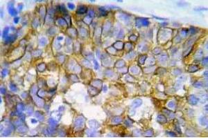 Immunohistochemistry (IHC) analyzes of p-Crk2 antibody in paraffin-embedded human lung adenocarcinoma tissue. (Crk 抗体  (pTyr221))