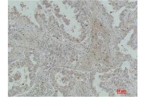 Immunohistochemical analysis of paraffin-embedded Human Lung Carcinoma using MICU1 Monoclonal Antibody. (MICU1 抗体)