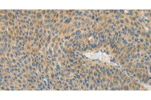 Immunohistochemistry of paraffin-embedded Human liver cancer using ASPA Polyclonal Antibody at dilution of 1:80 (ASPA 抗体)