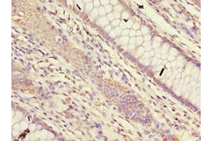 Immunohistochemistry of paraffin-embedded human colon cancer using ABIN7165410 at dilution of 1:100 (FAM149B1 抗体  (AA 107-528))
