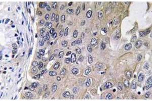Immunohistochemistry analysis of GCS-alpha-1 antibody in paraffin-embedded human lung carcinoma tissue. (GUCY1A1 抗体)