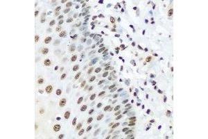 Immunohistochemical analysis of hnRNP R staining in human esophageal cancer formalin fixed paraffin embedded tissue section. (HNRNPR 抗体)