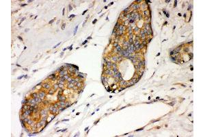 Anti- IKB alpha Picoband antibody, IHC(P) IHC(P): Human Mammary Cancer Tissue (NFKBIA 抗体  (AA 3-112))