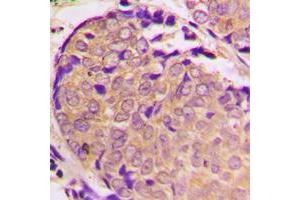 Immunohistochemical analysis of Alpha-synuclein (pS129) staining in human prostate cancer formalin fixed paraffin embedded tissue section. (SNCA 抗体  (C-Term, pSer129))