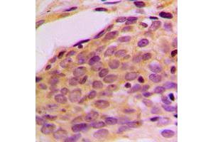Immunohistochemical analysis of p116 Rip staining in human breast cancer formalin fixed paraffin embedded tissue section. (MPRIP 抗体  (Center))