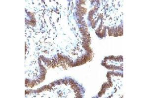 IHC testing of FFPE human ovarian carcinoma and EMI-1 antibody (FBXP5). (FBXO5 抗体  (N-Term))