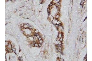 Anti-CDC42 antibody, IHC(P) IHC(P): Human Mammary Cancer Tissue (CDC42 抗体  (Middle Region))