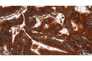 Immunohistochemistry of paraffin-embedded Human colon cancer tissue using GCKR Polyclonal Antibody at dilution 1:50 (GCKR 抗体)