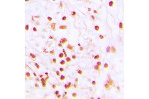 Immunohistochemical analysis of ERCC6 staining in human lung cancer formalin fixed paraffin embedded tissue section.