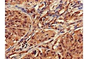 Immunohistochemistry of paraffin-embedded human lung cancer using ABIN7155530 at dilution of 1:100 (DOT1L 抗体  (AA 331-484))