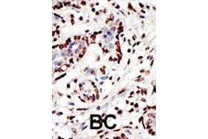 Formalin-fixed and paraffin-embedded human cancer tissue reacted with the MLL polyclonal antibody  , which was peroxidase-conjugated to the secondary antibody, followed by AEC staining. (MLL/KMT2A 抗体  (AA 312-343))