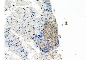 ABIN6258856 and ABIN6275099 at 1/100 staining Human pancreatic cancer by IHC-P. (INSL4 抗体  (Internal Region))