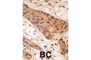 Formalin-fixed and paraffin-embedded human cancer tissue reacted with the primary antibody, which was peroxidase-conjugated to the secondary antibody, followed by AEC staining. (BNIP1 抗体  (AA 92-127))