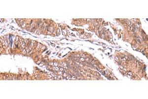 Immunohistochemistry of paraffin-embedded Human colorectal cancer tissue using GATM Polyclonal Antibody at dilution of 1:70(x200) (GATM 抗体)