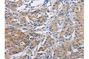 The image on the left is immunohistochemistry of paraffin-embedded Human lung cancer tissue using ABIN7128287(AGBL5 Antibody) at dilution 1/30, on the right is treated with fusion protein. (AGBL5 抗体)