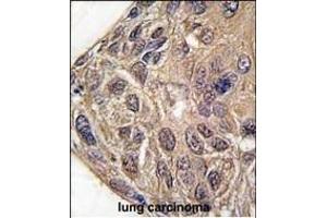Formalin-fixed and paraffin-embedded human lung carcinoma tissue reacted with YARS antibody (C-term) (ABIN391839 and ABIN2841678) , which was peroxidase-conjugated to the secondary antibody, followed by DAB staining. (YARS 抗体  (C-Term))