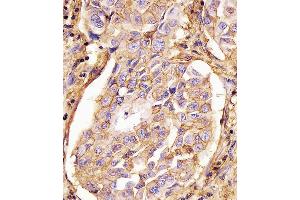 (ABIN659120 and ABIN2843760) staining CD44 in human lung adenocarcinoma tissue sections by Immunohistochemistry (IHC-P - paraformaldehyde-fixed, paraffin-embedded sections). (CD44 抗体)