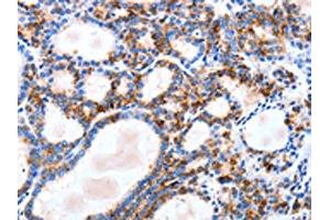 The image on the left is immunohistochemistry of paraffin-embedded Human thyroid cancer tissue using ABIN7129823(IGSF6 Antibody) at dilution 1/10, on the right is treated with fusion protein. (IGSF6 抗体)