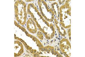 Immunohistochemistry of paraffin-embedded human kidney cancer using μgT1A4 antibody (ABIN5973231) at dilution of 1/200 (40x lens). (UGT1A4 抗体)