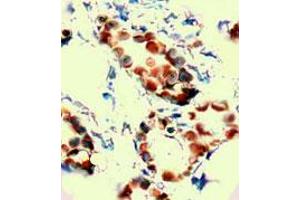 Immunohistochemical staining of human breast cancer tissue was stained with KDR polyclonal antibody  at 1 : 100 for 10 min at RT. (VEGFR2/CD309 抗体  (Extracellular Domain))