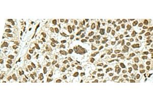Immunohistochemistry of paraffin-embedded Human esophagus cancer tissue using KHSRP Polyclonal Antibody at dilution of 1:50(x200) (KHSRP 抗体)