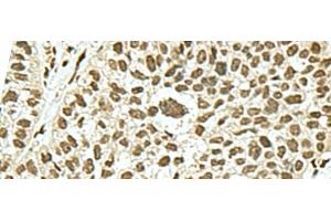 Immunohistochemistry of paraffin-embedded Human esophagus cancer tissue using KHSRP Polyclonal Antibody at dilution of 1:50(x200)