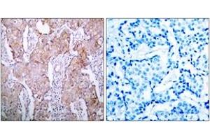 Immunohistochemistry analysis of paraffin-embedded human breast carcinoma, using EGFR (Phospho-Ser1070) Antibody. (EGFR 抗体  (pSer1070))