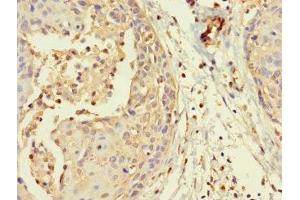 Immunohistochemistry of paraffin-embedded human cervical cancer using ABIN7160194 at dilution of 1:100 (MORC1 抗体  (AA 683-984))