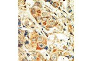 Formalin-fixed and paraffin-embedded human cancer tissue reacted with the primary antibody, which was peroxidase-conjugated to the secondary antibody, followed by DAB staining. (PKC alpha 抗体  (C-Term))