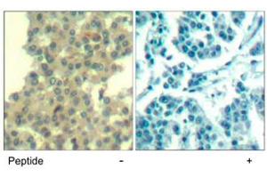 Immunohistochemical analysis of paraffin-embedded human breast carcinoma tissue using ERBB3 polyclonal antibody . (ERBB3 抗体  (Tyr1328))