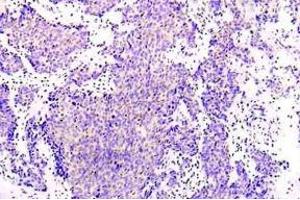 Immunohistochemistry (IHC) analysis of PRKAA1 antibody in paraffin-embedded human lung adenocarcinoma tissue. (PRKAA1 抗体)