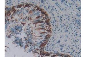 IHC-P analysis of Human Lung Cancer Tissue, with DAB staining. (PD-1 抗体  (AA 41-132))