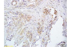 Formalin-fixed and paraffin embedded human cervical carcinoma labeled with Anti FUT8 Polyclonal Antibody, Unconjugated (ABIN716801) at 1:200 followed by conjugation to the secondary antibody and DAB staining (FUT8 抗体  (AA 311-410))