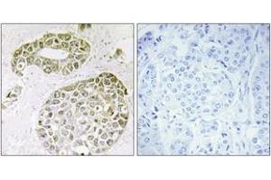 Immunohistochemistry analysis of paraffin-embedded human breast carcinoma tissue, using hnRNP M Antibody.
